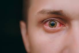 It was noted as perinatal hsv type infection: Herpes Infection Of The Cornea Harvard Health Blog Harvard Health Publishing