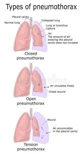 Image result for Open Pneumothorax