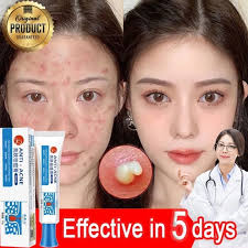 Acne Removal Cream penghilang flek hitam
