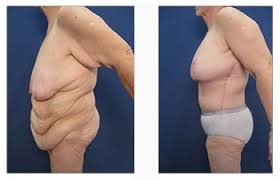With the help of these tips, you can be able to manage the issue of excess skin. How To Tighten Skin After Weight Loss Dr Mowlavi Plastic Surgery