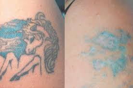 So far i did 3 laser sessions and every time it makes my skin red and it doesn't remove the ink. Red Green Blue Tattoo Removal Tattoo Removal Kochi
