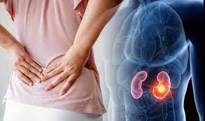 The human back, also called the dorsum, is the large posterior area of the human body, rising from the top of the buttocks to the back of the neck. When Back Pain Indicates Kidney Disease Ukraine Gate