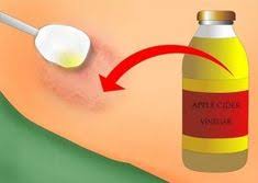 How does hand sanitizer work? 10 Home Remedies For Ringworm Skin Ideas Home Remedies For Ringworm Ringworm Ringworm Remedies