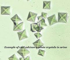 Actual Calcium Oxalate Crystals In Urine Asthma Symptoms Asthma Asthma Treatment