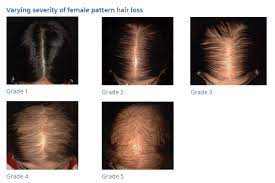Dhea has side effects involving both hair growth and hair loss. Hair Loss Archives Mynlrx