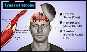 Types Of Stroke Ischemic Stroke Hemorrhagic Stroke Tia