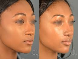 Beverly Hills Rhinoplasty Specialist Dr Donald Yoo Performed A Primary Rhinoplasty With Rib Cartilage Diced Cartilage Fascia Dcf And Alar Base Reduction On