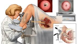 Image result for gambar pap smear