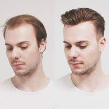 Non Surgical Vs Surgical Hair Replacement Which Is Best Best Hair Transplantation Dubai Hair Replacement Hair Transplant Best Hair Transplant