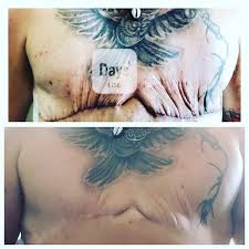 Non Binary Top Surgery Life Writ Large