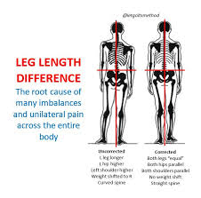 Image result for Functional Leg Length Discrepancy