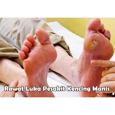 Saya ingatkan dia agar teruskan ambil ubat kencing manis. Ubat Gel Untuk Luka Diabetes Kencing Manis Bakar Shopee Malaysia