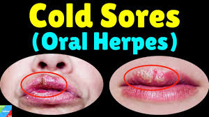 Image result for oral herpes symptoms roof of the mouth