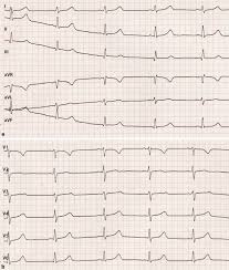 Myocarditis is an inflammatory disease of the myocardium that may present with sudden cardiac death, symptoms mimicking myocardial infarction, heart rhythm and conduction disorders. Ekg Befunde Tipps Und Tricks Zur Richtigen Diagnose Springerlink