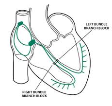 Image result for Left Bundle Branch Block