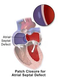 Image result for Atrial Septal Defect