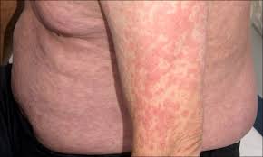 Image result for skin rash acute hiv infection