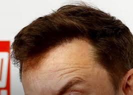 Elon thinning hair system with matrix 500 features a shampoo, conditioner and daily vitamin for complete rejuvenation. Elon Musk Hair Transplant History And Hair Analysis Before And After