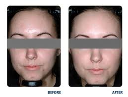 Blue Light Therapy For Acne