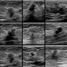 Review mammography, ultrasound, and mri findings with pathology correlation. The Radiology Assistant Ultrasound Of The Breast