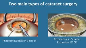 Image result for Cataract Extraction