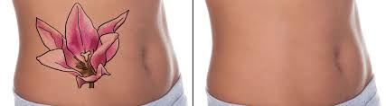 A wide variety of ipl tattoo removal options are available to you, such as nd: Laser Tattoo Removal Bridge City Tx Ipl Tattoo Removal