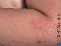 Image result for scabies on humans