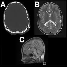 6 beaten copper appearance (bca) thought to correspond to the gyral pattern of the underlying brain significance has been debated, but is generally felt to be a 'normal' finding in children du boulay g: Conservative And Operative Management Of Iatrogenic Craniocerebral Disproportion A Case Based Review Springerlink