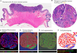 Stage 3 colon cancer is typically treated with surgical resection, in which a surgeon will remove the affected portion of the colon. Tumour Budding Poorly Differentiated Clusters And T Cell Response In Colorectal Cancer Ebiomedicine