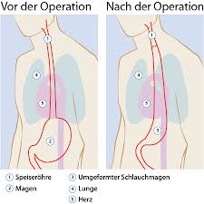 Behandlungsmethoden Bei Speiserohrenkrebs Klinikum Luneburg