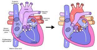 Hypoplastic Left Heart Syndrome Wikipedia