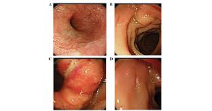 Advanced stomach cancer means that a cancer that began in the stomach has spread to at least one other part of the body, such as the liver or lungs. High Efficacy Of Combination Chemotherapy With S 1 And Low Dose Docetaxel For The Treatment Of Highly Advanced Gastric Cancer With Peritoneal Dissemination A Case Report