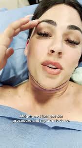 Rich Royal Chin AirSculpt