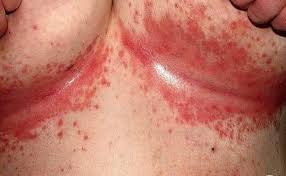 Image result for heat rash under breasts