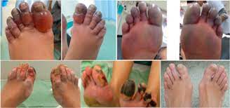 Frostbite stages and symptoms include burning, numbness, tingling, and itching of the skin. Case Report Severe Frostbite In Extreme Altitude Climbers The Kathmandu Iloprost Experience Wilderness Environmental Medicine