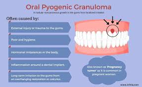 Image result for granuloma gum disease