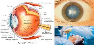 This is the most common type of surgery. Cataract Surgery Chippewa Valley Eye Clinic