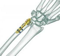 TRUE LOCK Distal Ulna Anatomic Plate | TRUEMED Medikal