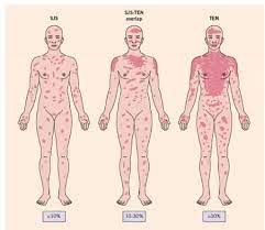 14 steven johnson syndrome pictures. Stevens Johnson Syndrome And Toxic Epidermal Necrolysis Rush Emergency Medicine