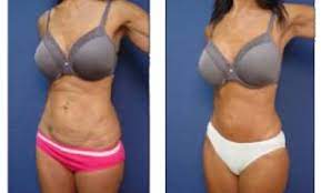 Nov 11, 2020 · a tummy tuck, or abdominoplasty, is a surgical procedure that improves abdominal contours by removing excess skin and fat while tightening the muscles. Tummy Tuck Dr Laguna Orange County California
