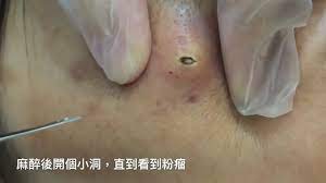 Video Tarda Seis Minutos En Extraer Todo El Pus De Un Gigantesco Grano En La Cara