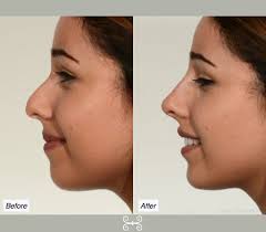 Non-Surgical Nose Job, Charleston