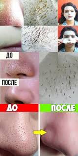 как убрать черные точки на носу в домашних условиях Chudo Maska S Legkostyu Uberet Nenavistnye Chernye Tochki I Dazhe Usiki Ej Pod Silu Skin Care Natural Beauty Skincare Avocado Beauty