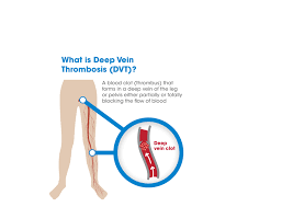 Pin On Dvt And Pe Visualized