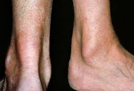 Leg Pain Causes And Treatment For Leg Calf And Thigh Pain