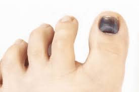 This bruised toenail has a white mark where the damage was caused and the mark looks like blood. Black Toenails Bumps And Bruises Next Step Foot Ankle Clinic
