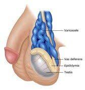Image result for Varicocele