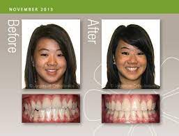Before After This A Rare Case Where We Were Able To Fix An Underbite Without Jaw Surgery Www Gregjorgensen Com Affordable Braces Orthodontics Jaw Surgery