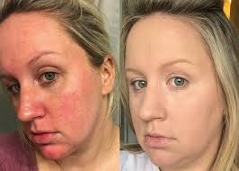 People On Reddit Are Posting Photos Proving This Bye Bye Redness Cream Actually Works Bye Bye Redness It Cosmetics Bye Bye Redness Redness