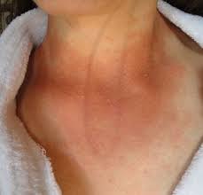 How To Fight Candida Naturally Yeast Infection Treatment Yeast Infection Symptoms Candida Symptoms